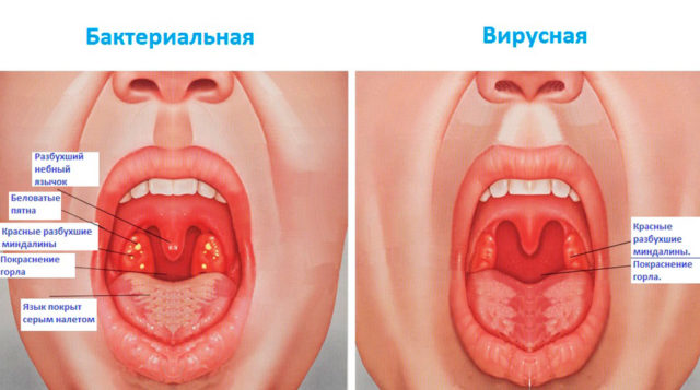 Прополіс при ангіні у дорослих і дітей: полоскання горла при тонзиліті