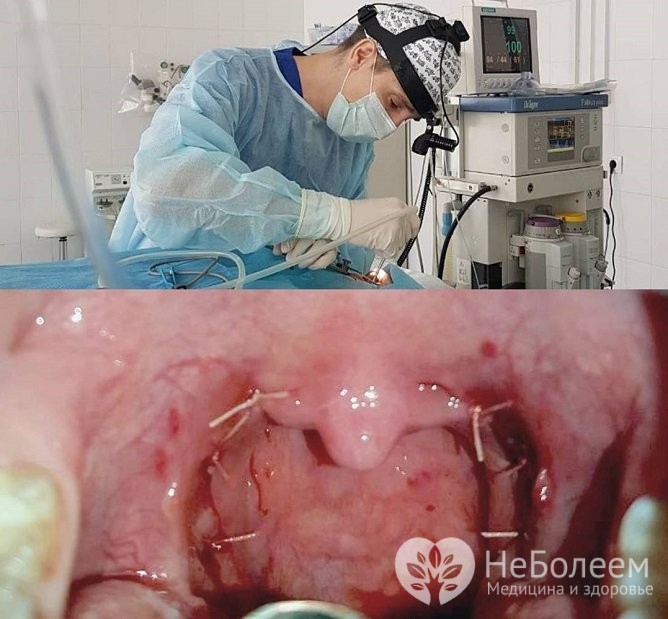 Проведення операції з видалення мигдаликів при хронічному тонзиліті і реабілітація після