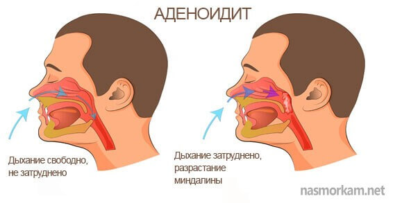Прозорі соплі у дорослої людини. Про яких захворюваннях кажуть зелені соплі