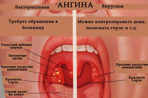 Психосоматика тонзиліту: психосоматичні причини хронічної форми у дітей і дорослих