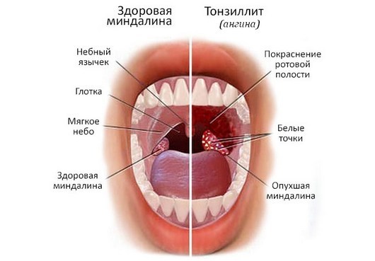 Пухке горло причини і лікування