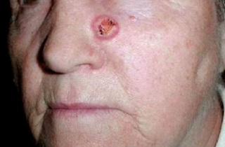 Пухлина носа види симптоми причини