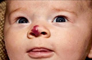 Пухлина носа види симптоми причини