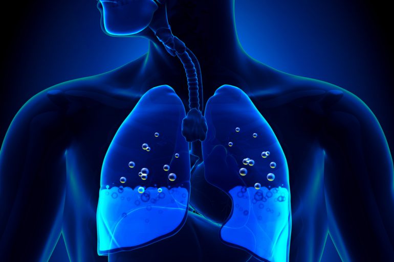 Рідина в легенях лікування народними засобами