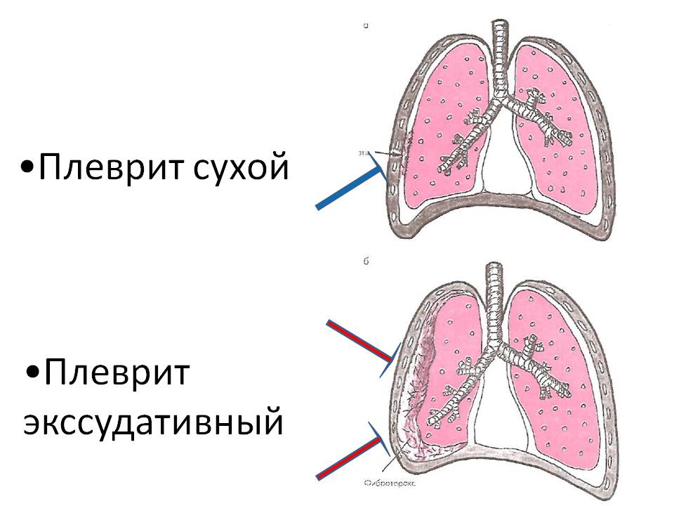 Рідина в легенях лікування народними засобами