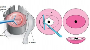 Радіохвильова ексцизія шийки матки та інші види цієї операції показання підготовка післяопераційний період