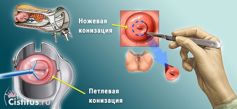 Радіохвильова ексцизія шийки матки та інші види цієї операції показання підготовка післяопераційний період
