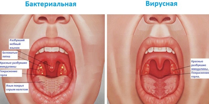 Распространнные хвороби горла у дітей і дорослих
