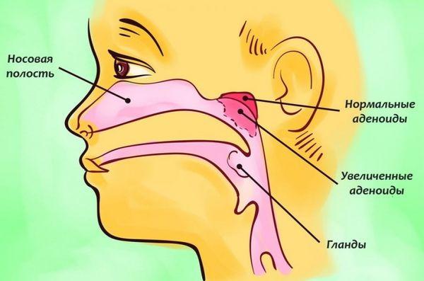 Реабілітація після тонзилектомії що можна їсти скільки болить горло лікування