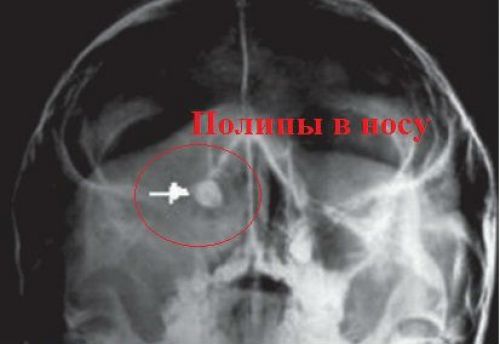 Рентген пазух носа: як роблять і як розшифрувати знімок