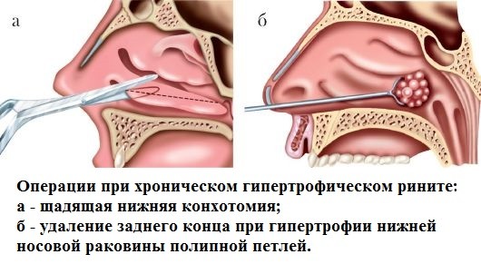 Риніт гостра і хронічна форма