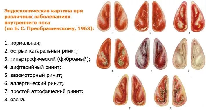 Риніт лікування в залежності від характеру хвороби