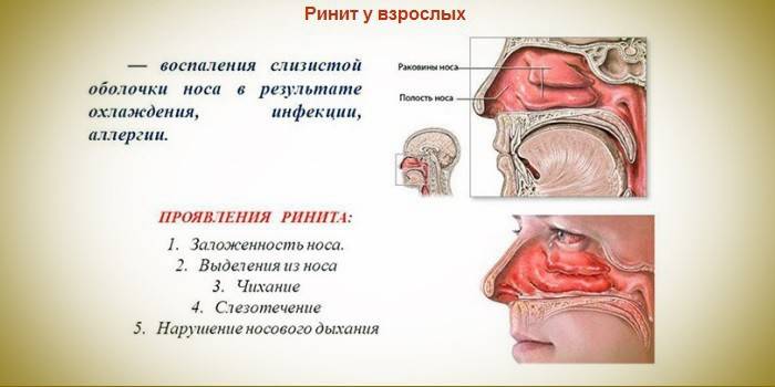 Риніт: симптоми захворювання і його види
