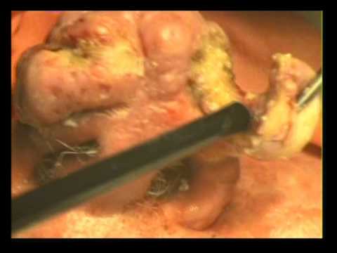 Ринофіма носа – причини, лікування та профілактика