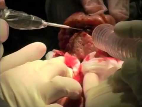 Ринофіма носа – причини, лікування та профілактика