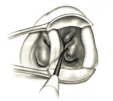 Риноскопія і ендоскопія як проводять діагностику носової порожнини