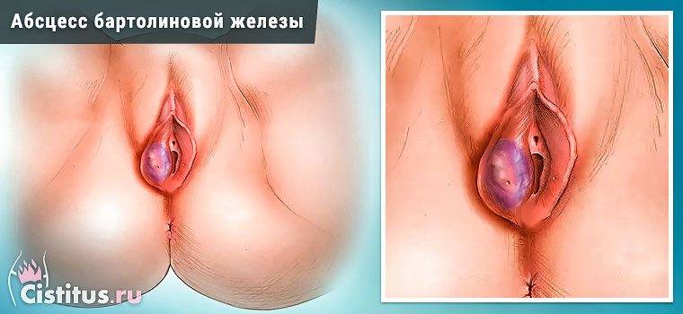 Розтин абсцесу бартолиновой залози: показання для призначення