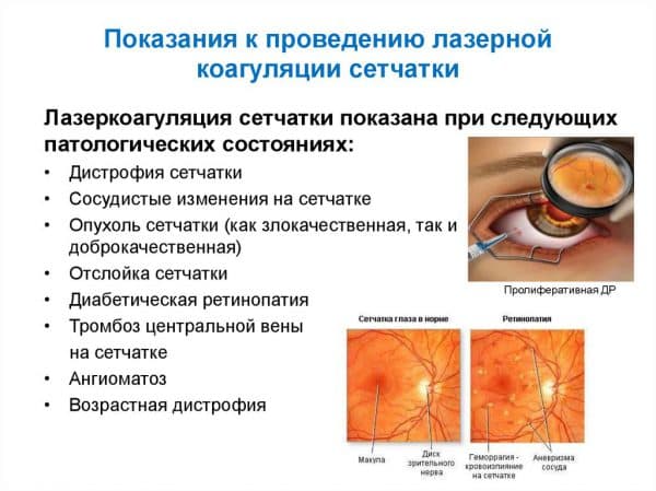 Сітківка ока лікування народними засобами