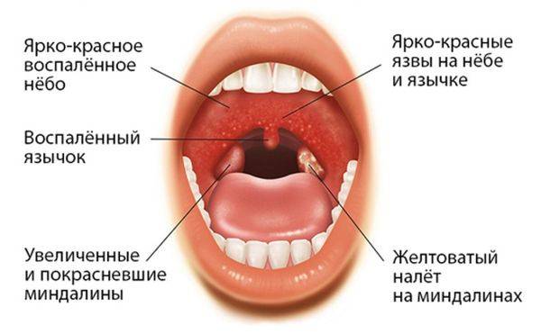 Що краще ефективніше Синупрет або Тонзилгон