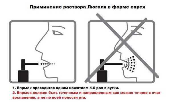 Що лікує люголь. Ознаки фарингіту і ефективне лікування захворювання з допомогою люголя