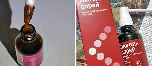 Що лікує люголь. Ознаки фарингіту і ефективне лікування захворювання з допомогою люголя