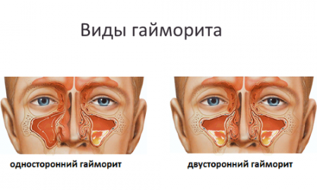 Що можна виявити за допомогою УЗД пазух носа