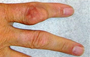 Що не можна їсти при подагрі і що можна список продуктів і таблиця