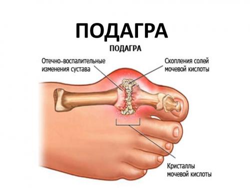 Що не можна їсти при подагрі і що можна список продуктів і таблиця