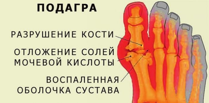 Що не можна їсти при подагрі і що можна список продуктів і таблиця