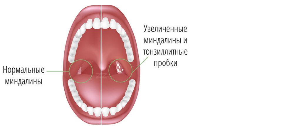 Що представляють собою казеозные пробки на лакунах мигдаликів, способи лікування тонзилитных пробок, фото
