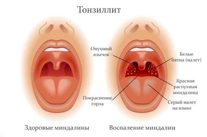 Що представляють собою казеозные пробки на лакунах мигдаликів, способи лікування тонзилитных пробок, фото