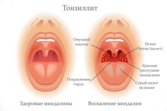 Що представляють собою казеозные пробки на лакунах мигдаликів, способи лікування тонзилитных пробок, фото