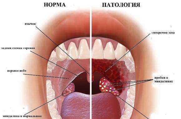 Що представляють собою казеозные пробки на лакунах мигдаликів, способи лікування тонзилитных пробок, фото