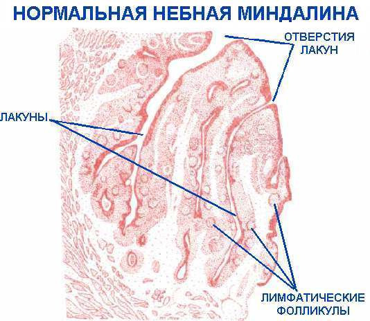 Що представляють собою казеозные пробки на лакунах мигдаликів, способи лікування тонзилитных пробок, фото