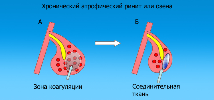 Що робити, якщо постійно закладений ніс не дихає