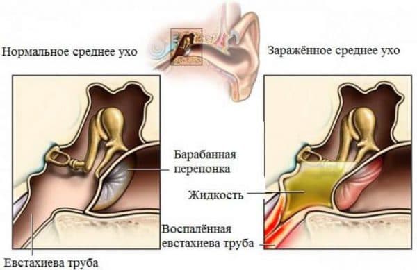 Що робити якщо заклало вухо при нежиті