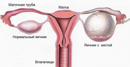 Що таке ендометріоз яєчника як він виявляється і чим його лікують