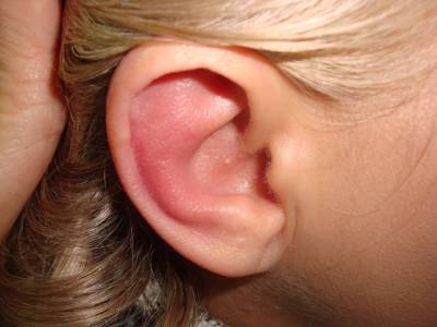 Що таке гіперемія слухового проходу і як вона лікується