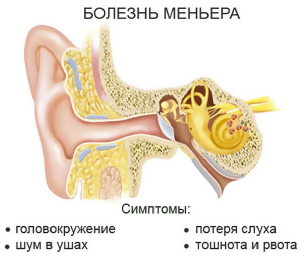 Що таке хвороба Меньєра симптоми і лікування