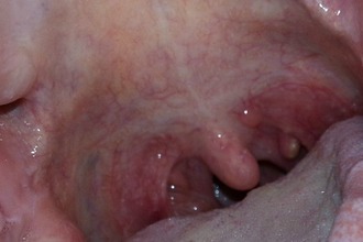 Що таке кіста в горлі – симптоми і лікування 2019