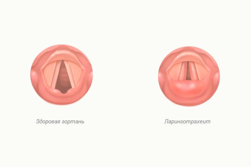 Що таке ларинготрахеїт