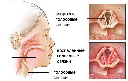 Що таке ларинготрахеїт