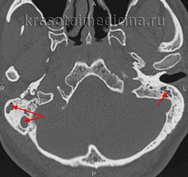 Що таке мастоїдит особливості симптоми лікування і прогноз Що таке мастоїдит особливості симптоми лікування і прогноз