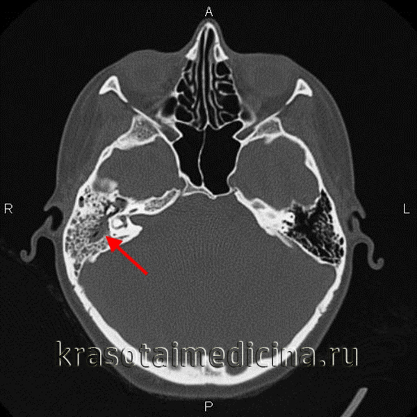Що таке мастоїдит особливості симптоми лікування і прогноз Що таке мастоїдит особливості симптоми лікування і прогноз