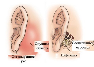 Що таке мастоїдит особливості симптоми лікування і прогноз Що таке мастоїдит особливості симптоми лікування і прогноз