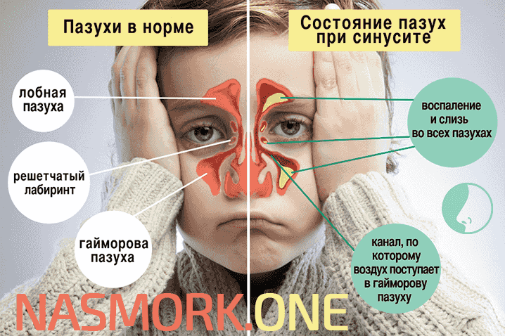 Що таке медикаментозний нежить і як з ним правильно боротися