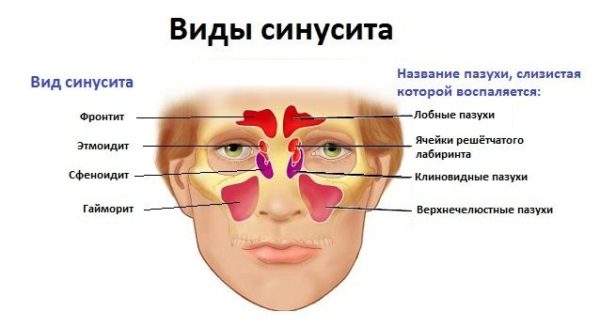Що таке СИНУСИТ, симптоми і лікування у дорослих Що таке СИНУСИТ, симптоми і лікування у дорослих