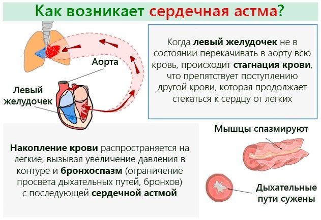 Серцева астма симптоми і лікування