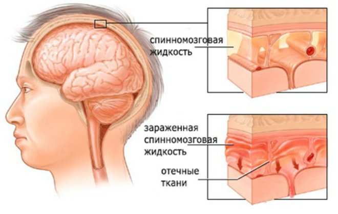Серозний (вірусний) менінгіт: причини, симптоми і діагностика. Лікування серозного менінгіту в Москві