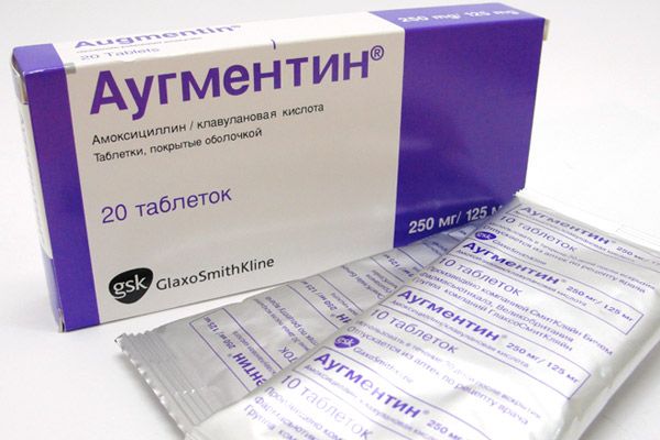 Сфеноидит як виявити і лікувати це захворювання